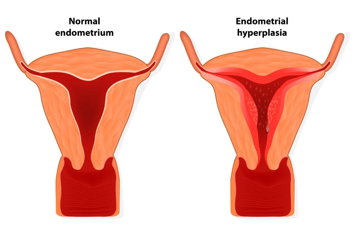 Normal Endometrium vs endometrial Hyperplasia