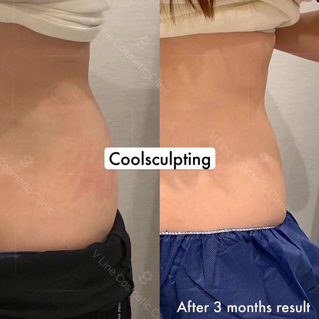 A coolsculpting before and after photo of a client at our Toronto clinic