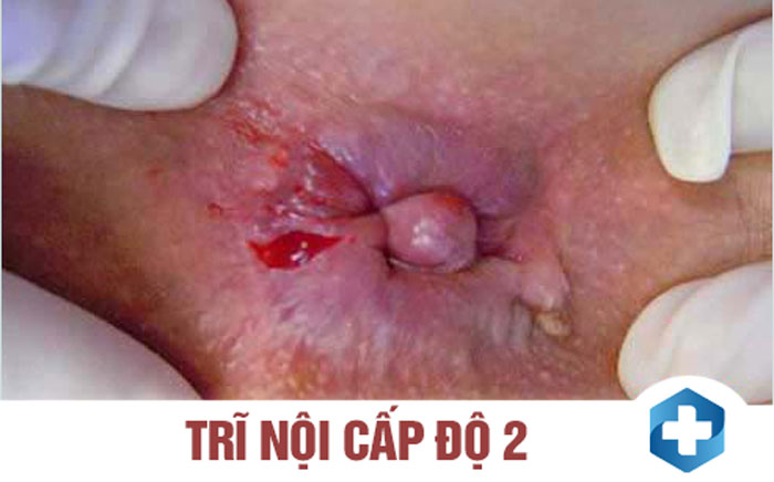 triệu chứng bệnh trĩ nội