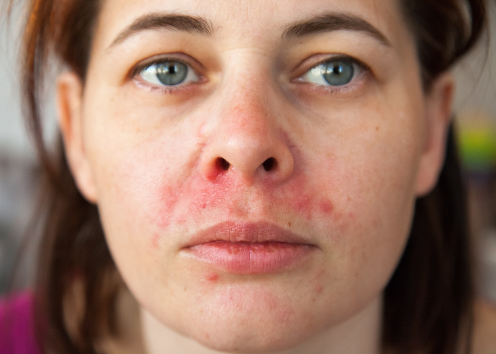 لماذا يحدث التهاب الجلد حول الفم