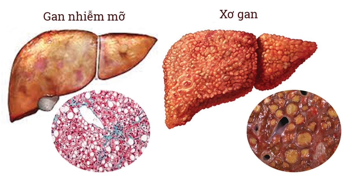 Gan nhiễm mỡ không được phát hiện và điều trị sớm dễ dẫn đến xơ gan