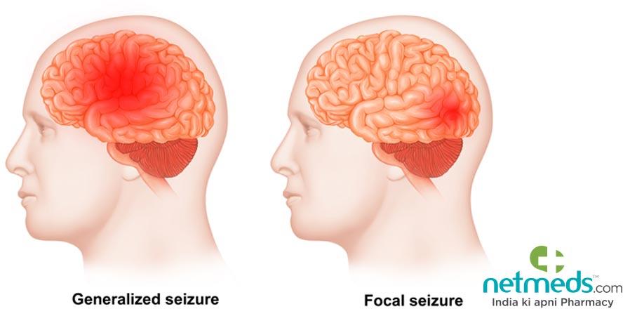 Focal Onset Seizures/Partial Seizures: Causes, Symptoms And Treatment