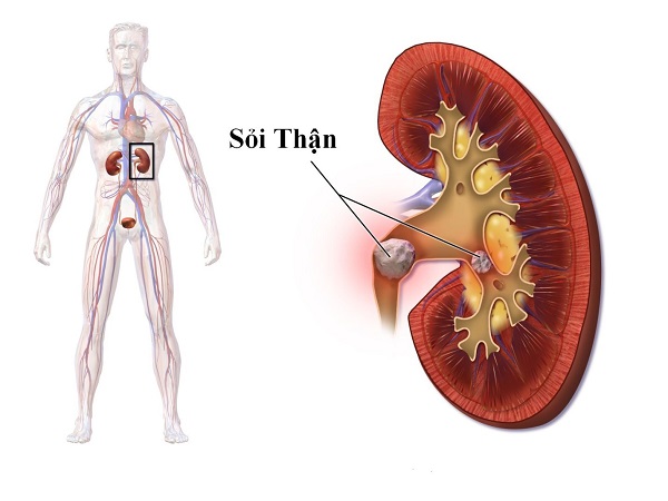 nguyên nhân sỏi thận