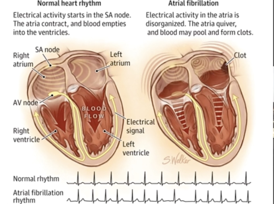 Normal heart rhythmn vs atrial fibrillation