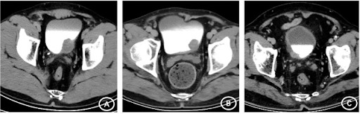 Tomografia computadorizada da pelve em fase excretora tardia. O contraste já foi filtrado pelos rins e agora está sendo excretado na urina que aparece hiperatenuante (branca) preenchendo a bexiga. Note como esta fase torna fácil a detecção de lesões polipoides neoplásicas nas paredes da bexiga.