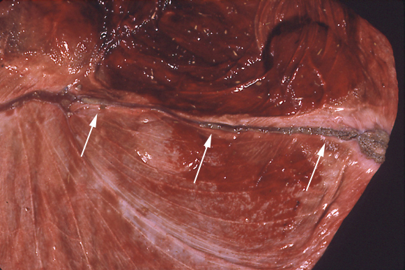 Remnant of the placenta from the dead twin fetus is present along the chorionic surface of the remaining singleton placenta at term as a linear band (arrows).