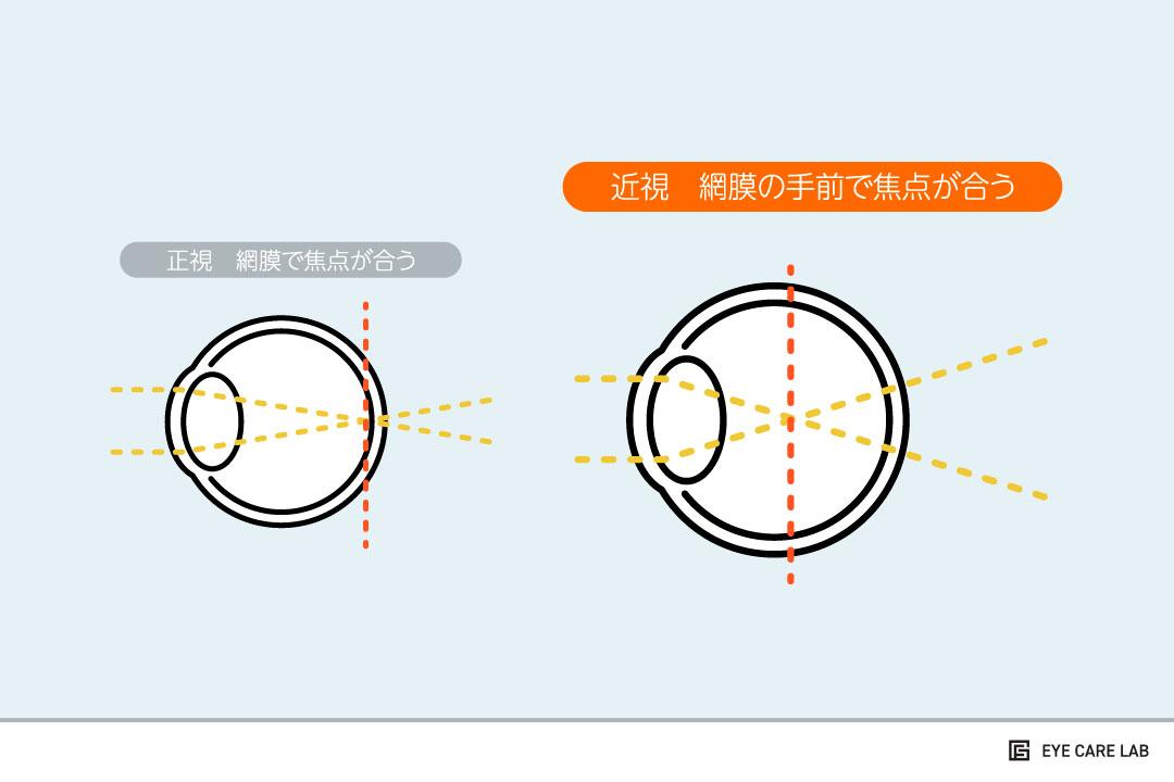近眼 近視 とは 近眼の原因と遠視 老眼との違いを解説 グラスファクトリー Eye Care Lab
