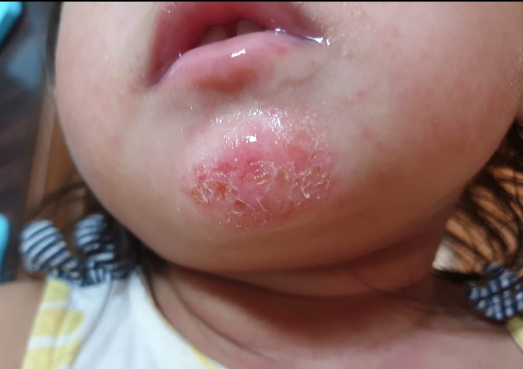 Above: 18-month old baby eczema on chin