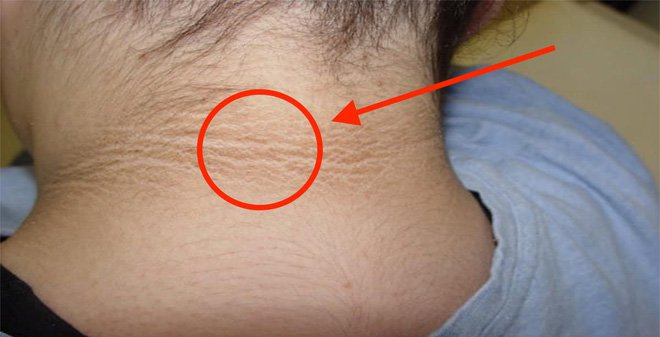 Rất khó để nhận biết triệu chứng của tiền tiểu đường