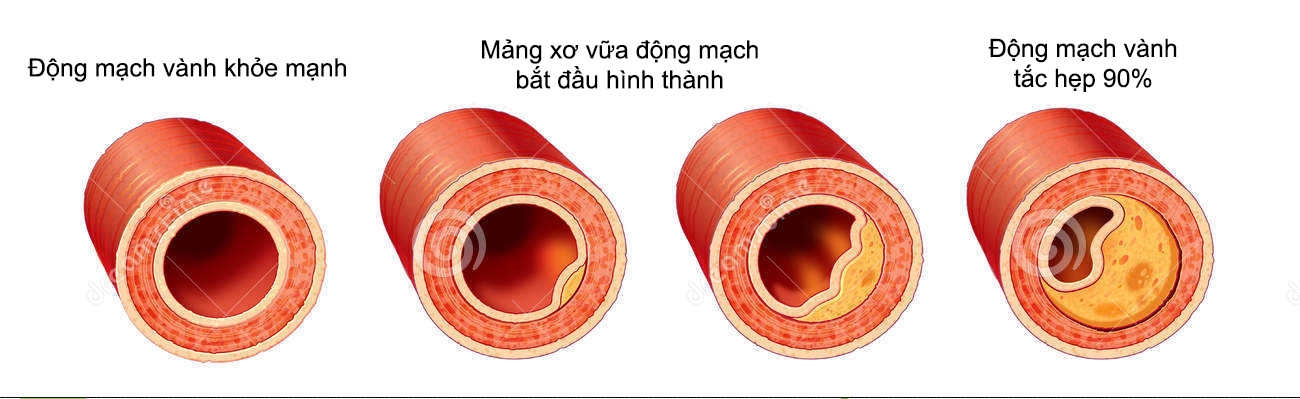 Kết quả hình ảnh cho quá trình hình thành mảng xơ vữa động mạch