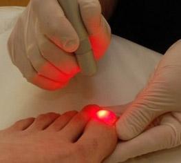 Červené světlo se používá k léčbě houby nehtů na nohou