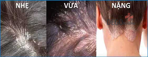 Các giai đoạn của bệnh nấm da đầu