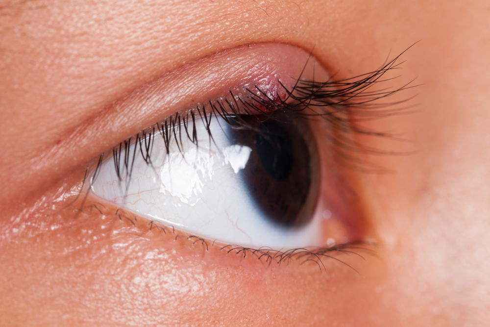 blefarita nu afectează vederea