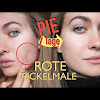 Pickelmale Loswerden / Kleine Pickel Im Gesicht Ursachen 8 Tipps Desired De / 6 tipps wendet ihr folgende produkte nach einer aknebehandlung alleine oder auch in kombination miteinander an, könnt ihr den nervigen pickelmalen und sogar auch pickelnarben ganz schnell tschüss sagen, denn sie helfen beim abheilen und loswerden der fiesen flecken und einkerbungen.