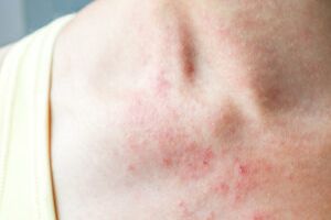 Eccema o dermatitis atópica