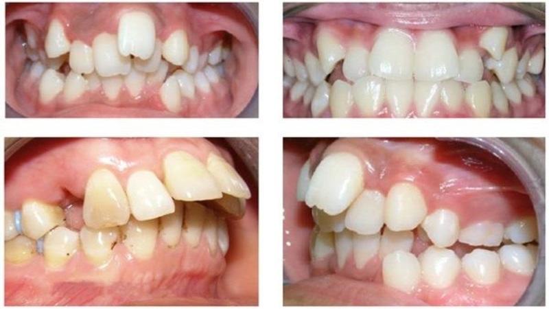 niềng răng Phòng tránh các bệnh lý về răng miệng