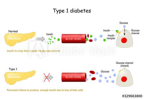 Types 1 of Diabetes Mellitus.