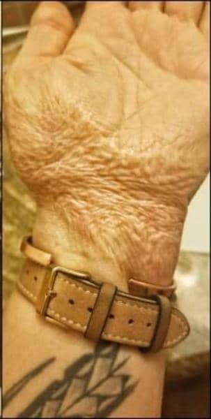 Motorcyclist proudly shows healed road rash scars