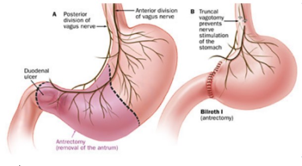 Figura 3: Antrectomia e vagotomia troncular com anastomose em Billroth I; Vagotomia troncular e piloroplastia..