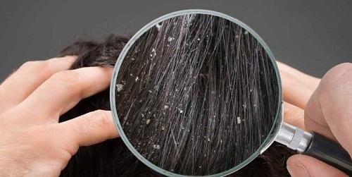 man-hair-dandruff-closeup-fb-1.jpg