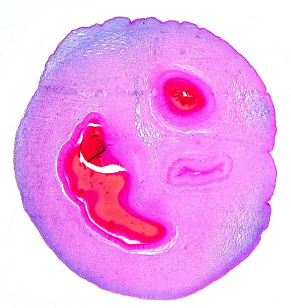 Cross section of umbilical cord with thee blood vessels