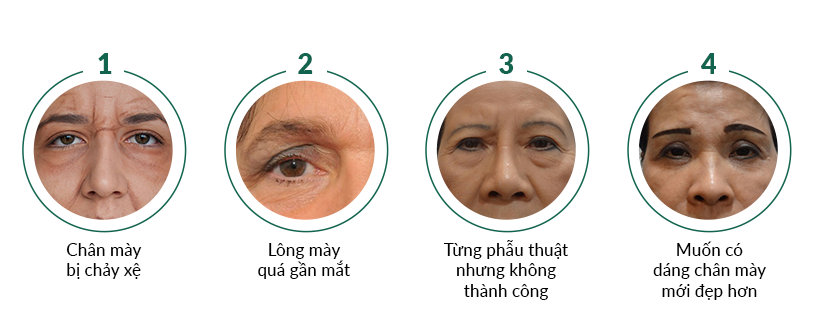 Nâng cung mày được xem là giải pháp hữu hiệu nhất trong việc giải quyết các tình trạng chân mày chảy xệ khiến mí mắt sụp, mắt bị che khuất tầm nhìn, nếp nhăn vết chân chim khóe mắt,...