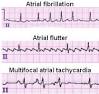 Image result for arrhythmia ecg examples