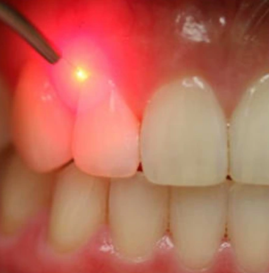 Lasers in Dentistry: Minimally Invasive Instruments for the Modern Practice