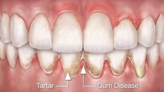 Periodontal Disease, Prevention and Treatment