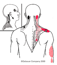 Trapezius trigger point 7