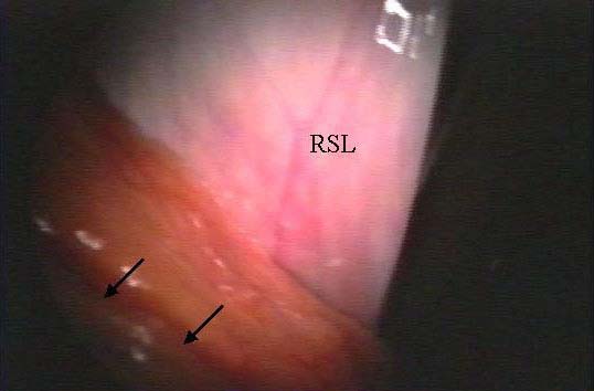 Laparoscopía en estación, vista del lado izquierdo. RSL: ligamento nefroesplénico; flecha: bazo.