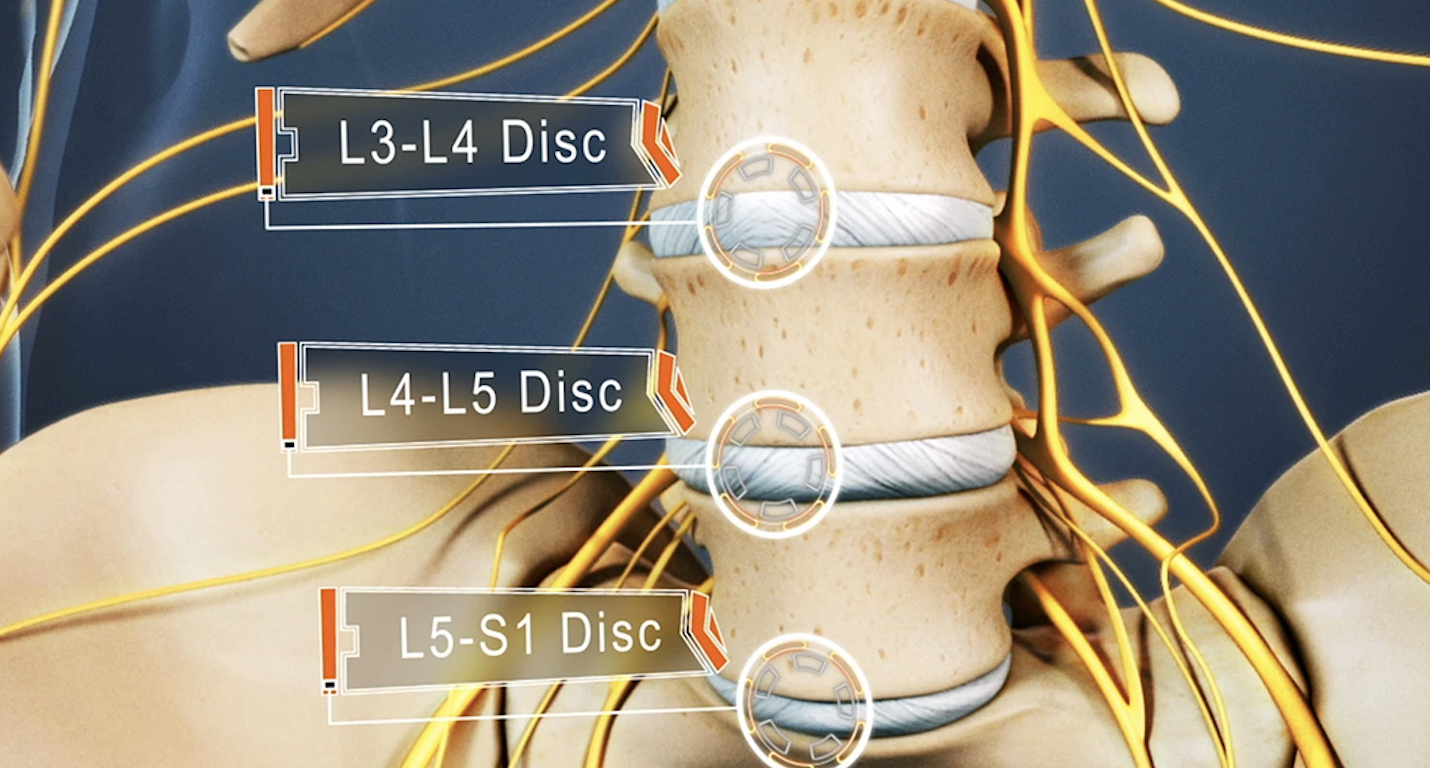 L5 s1 позвоночника протрузия пояснично крестцового отдела. Диски l5-s1 в позвоночнике. Межпозвонковые диски l3-s1. Протрузия диска l4-s1. Межпозвонковый диск l5-s1.