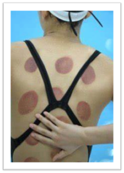 Cupping Therapy Colorado Springs - Cupping Massage