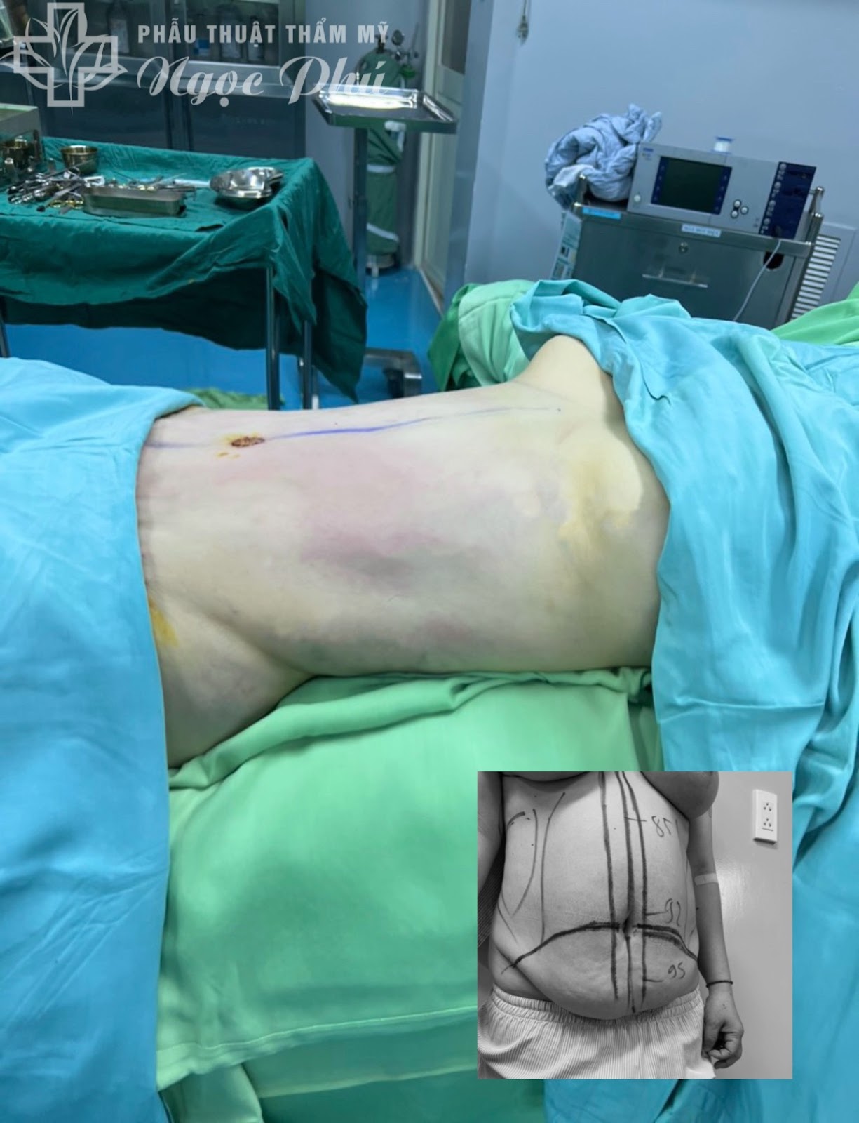 Hình ảnh khách hàng trước và sau khi hút mỡ bụng tại Phẫu thuật Thẩm mỹ Thẩm Mỹ Việt Nam