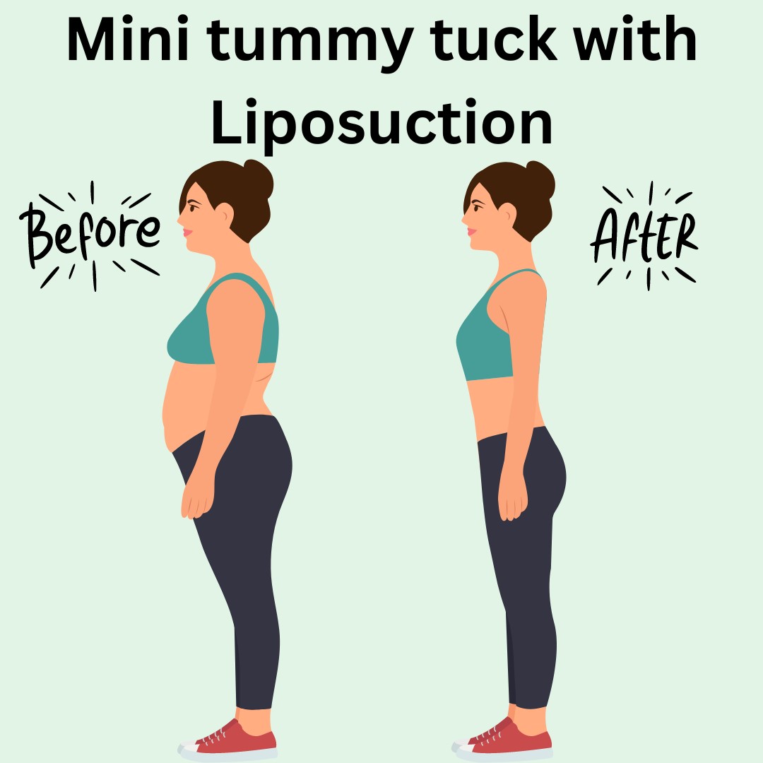 mini tummy tuck with lipo before/after