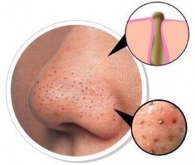 Blackheads