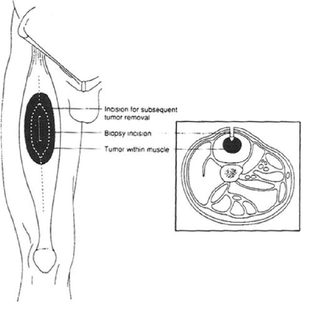 ಮೃದು ಅಂಗಾಂಶ ಸಾರ್ಕೋಮಾ