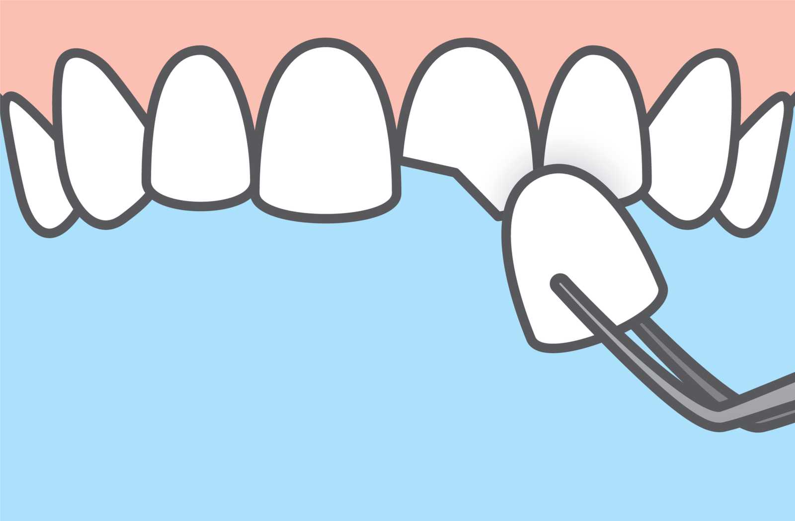 illustration of veneer covering chipped tooth with bright blue background