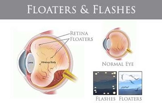 Image result for flashes and floaters