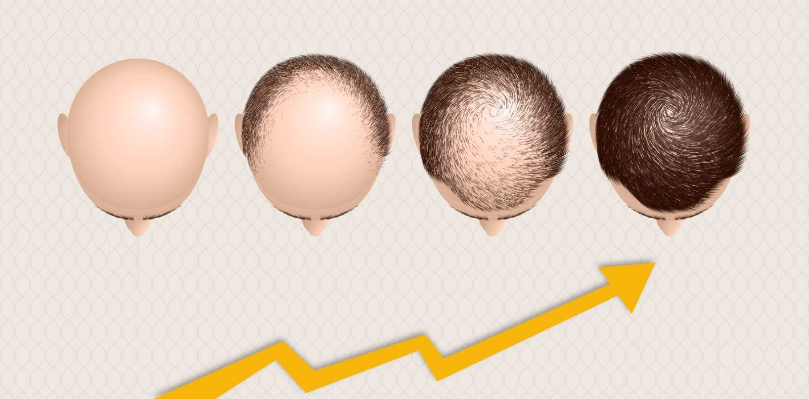 What is the Procedure of PRP Hair Transplant in Jaipur - Dr Sachin Sharda