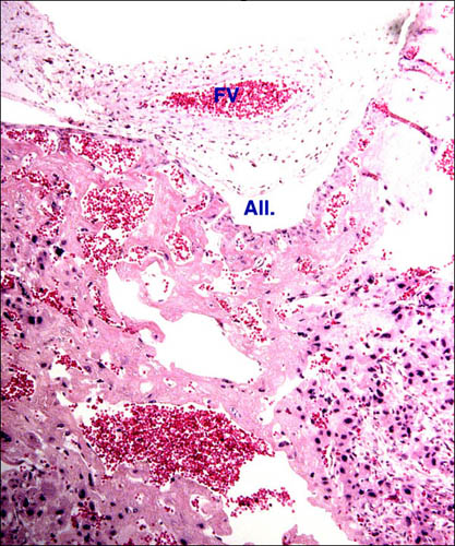 Fetal surface of disc with fetal vessel, small allantoic cavity, and large (central) maternal channel. In a few areas one may see some endothelial cells.