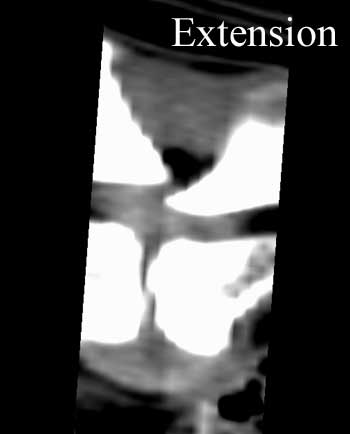 Sagittal, flexion and extension CT images of a dog with lumbosacral stenosis and dynamic subluxation