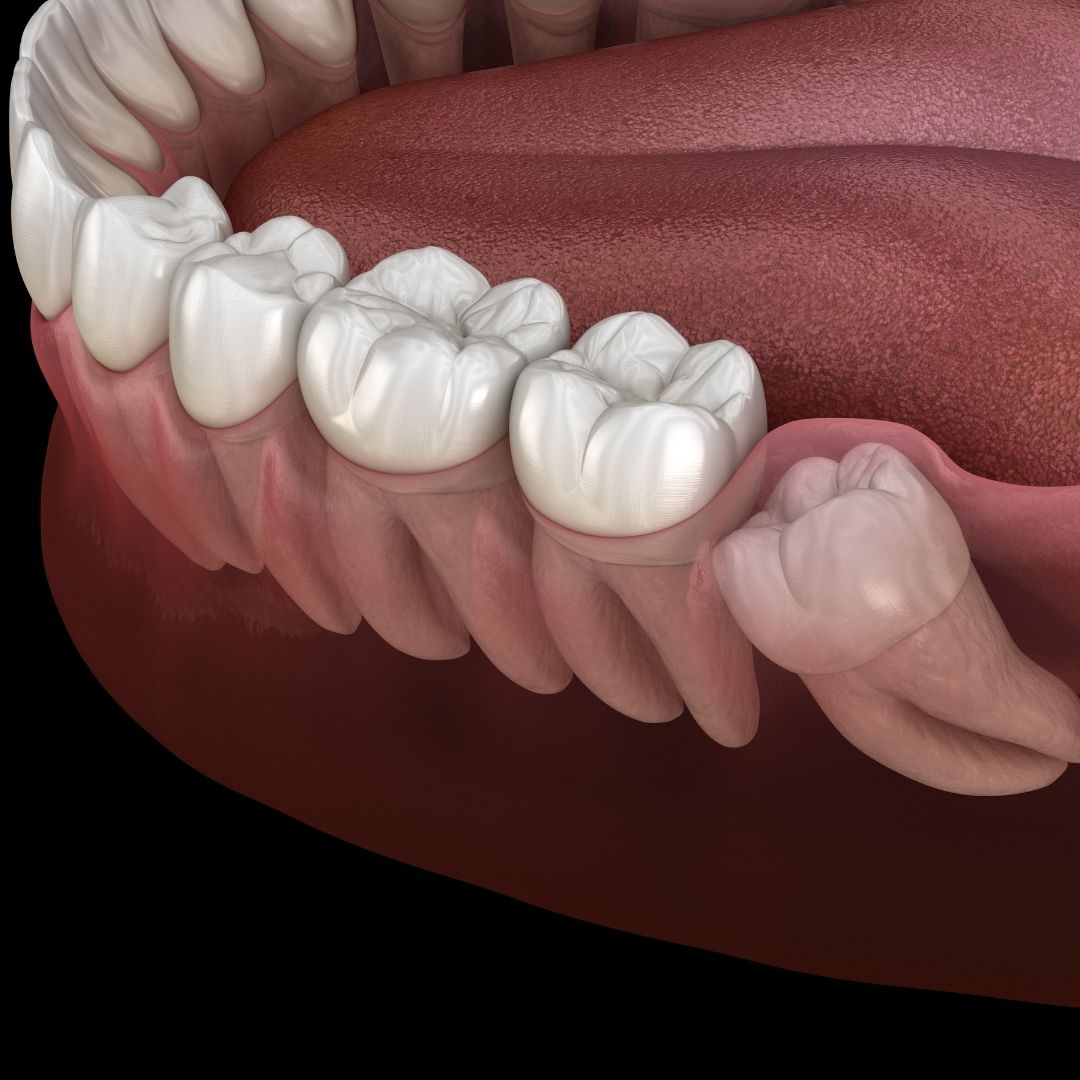 Wisdom teeth inside gum