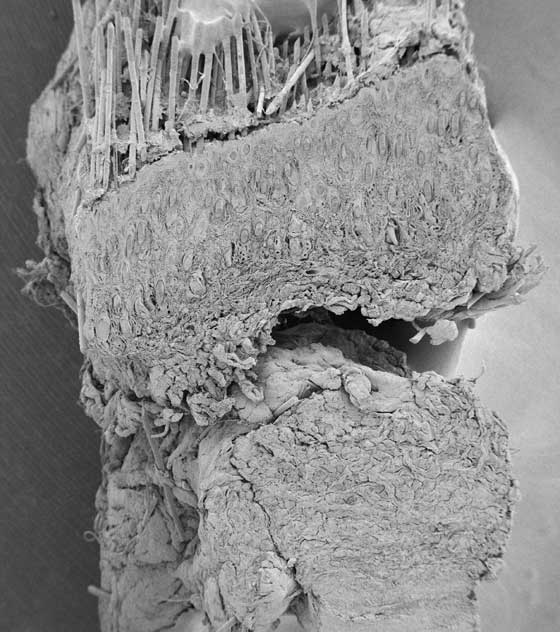 SEM of an HC lesion. Note that the superficial and deep dermis layers are separated.