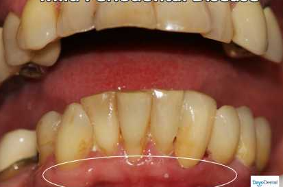 Stage 3- Moderate Periodontal