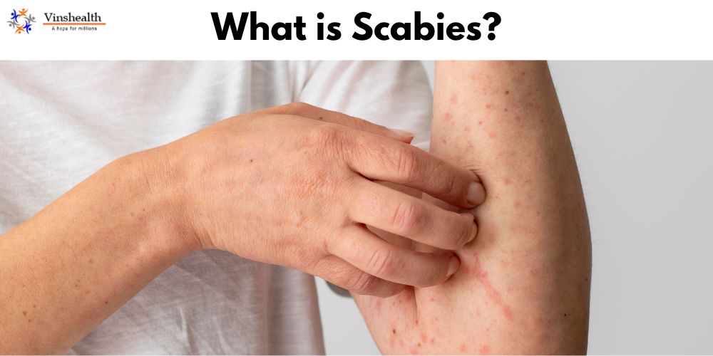 Scabies, Symptoms & Treatment