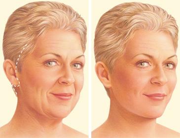 F:\aura\webpage\COSMETIC SURGERIES\FACE AND NECK CONTOURING\facelift-surgery-traditional-incision.jpg