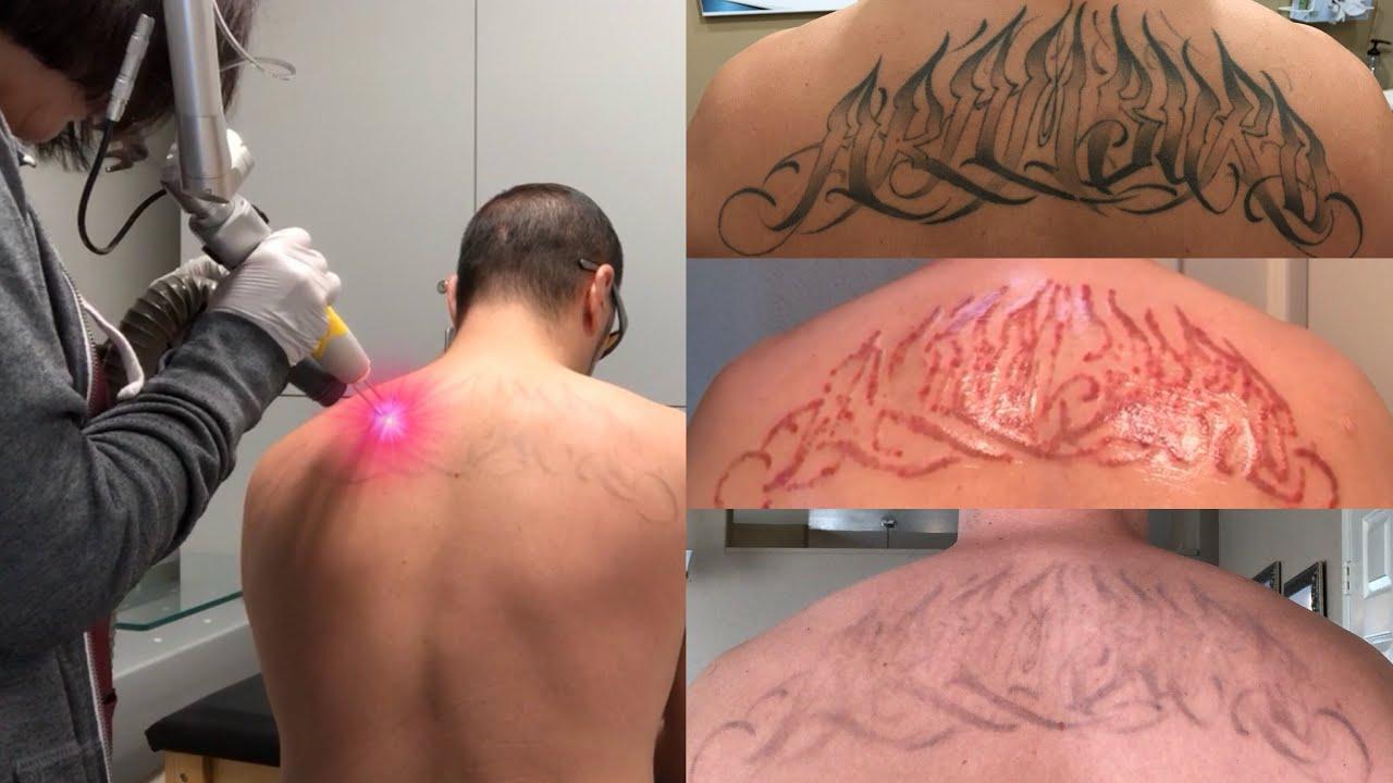 Laser Tattoo Removal - The Ugly Truth - YouTube