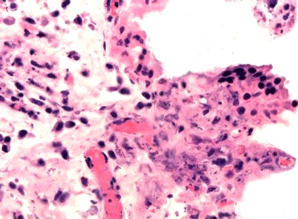 Villi of immature Brucella-infected placenta
