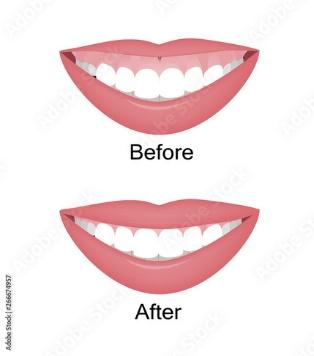 Mouth with a high smile line or gummy smile before and after the orthotropics, orthotropics or botox injections correction. Vector illustration